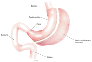 Sleeve Gastrectomy chirurgia bariatrica contro l'obesità Centro Specialistico San Martino Vergiate Varese